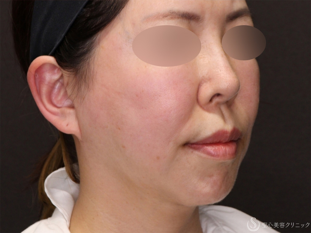 【50代女性・脂肪吸引と糸リフトでたるみのないスッキリとした顔に】ベイザーリポ2.2脂肪吸引＋アンカーDXダブル（バイニードル）（半年後） After 
