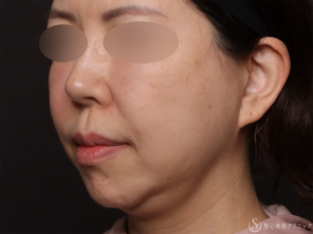 【50代女性・脂肪吸引と糸リフトでたるみのないスッキリとした顔に】ベイザーリポ2.2脂肪吸引＋アンカーDXダブル（バイニードル）（半年後） Before 