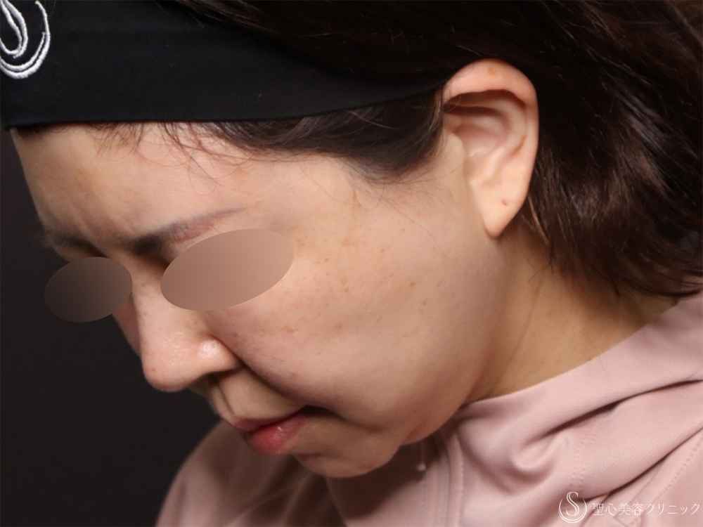 【50代女性・脂肪吸引と糸リフトでたるみのないスッキリとした顔に】ベイザーリポ2.2脂肪吸引＋アンカーDXダブル（バイニードル）（半年後） Before 
