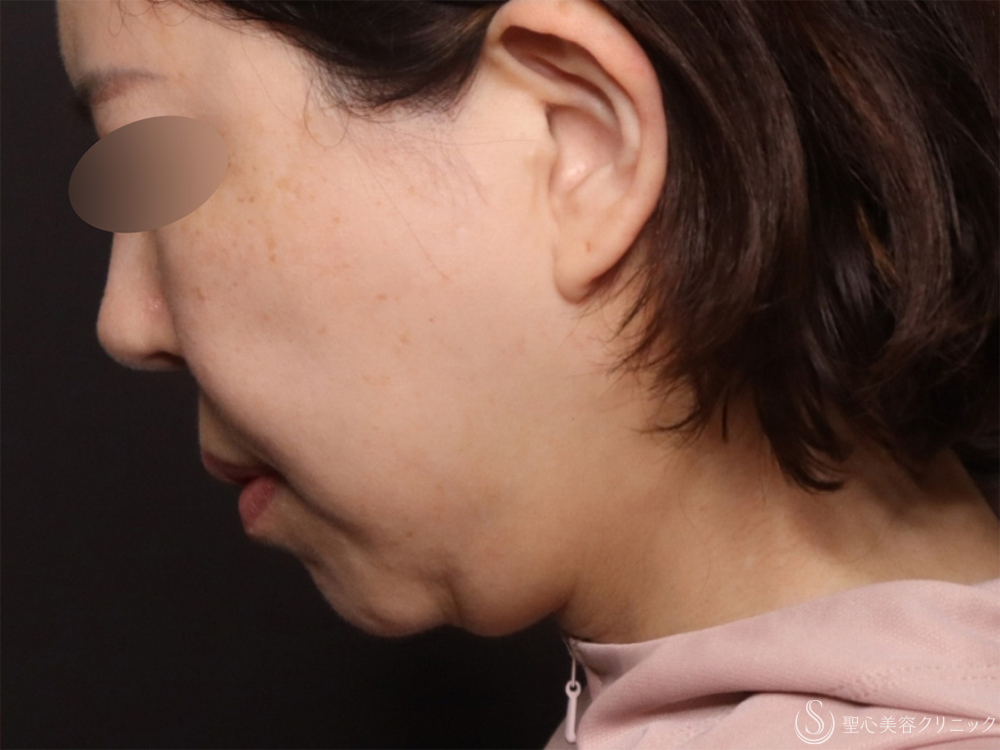 【50代女性・脂肪吸引と糸リフトでたるみのないスッキリとした顔に】ベイザーリポ2.2脂肪吸引＋アンカーDXダブル（バイニードル）（半年後） Before 