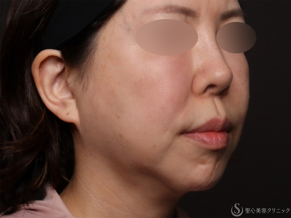 【50代女性・脂肪吸引と糸リフトでたるみのないスッキリとした顔に】ベイザーリポ2.2脂肪吸引＋アンカーDXダブル（バイニードル）（半年後） Before 