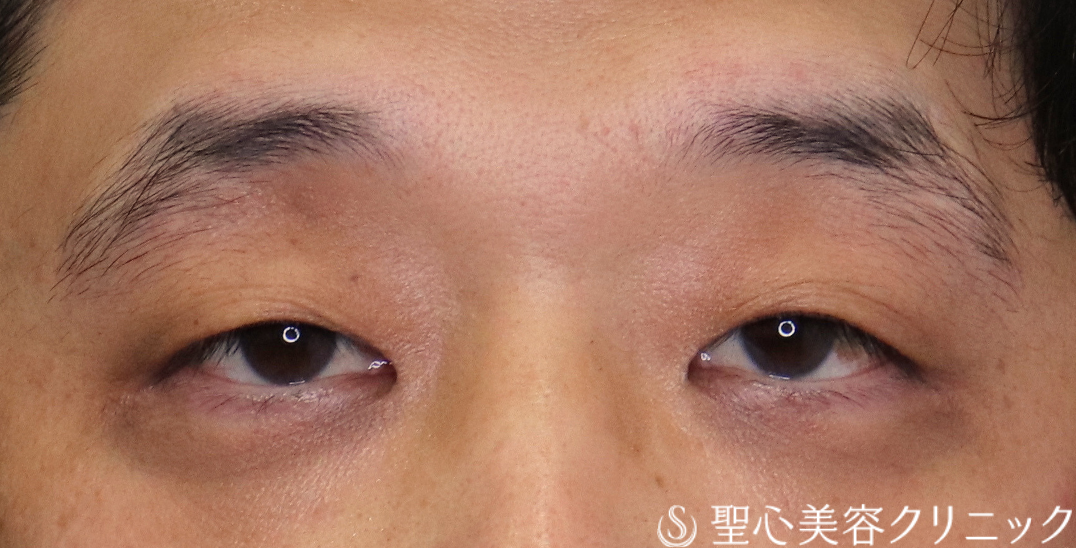 【40代男性・額や眉に力を入れず、楽に目を開けられるように】眼瞼下垂（切開法/腱膜縫縮法）（術後2ヶ月） Before 