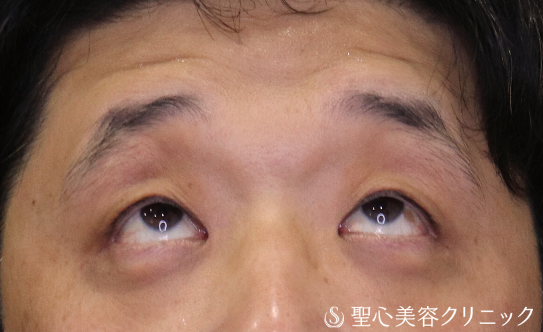 【40代男性・額や眉に力を入れず、楽に目を開けられるように】眼瞼下垂（切開法/腱膜縫縮法）（術後2ヶ月） Before 