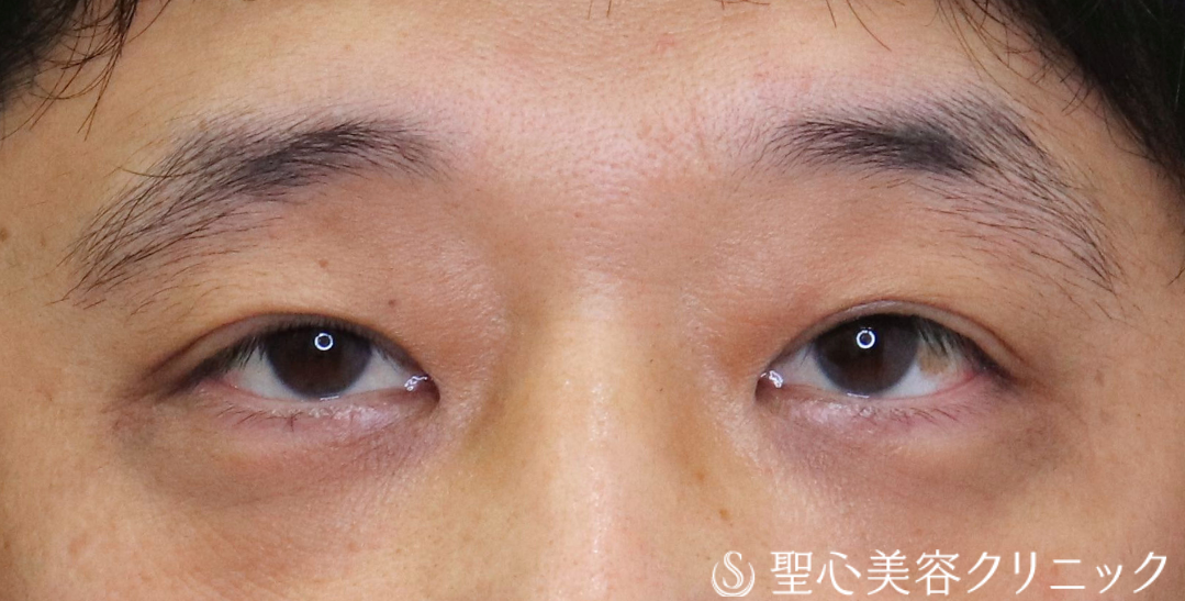 【40代男性・額や眉に力を入れず、楽に目を開けられるように】眼瞼下垂（切開法/腱膜縫縮法）（術後2ヶ月） After 
