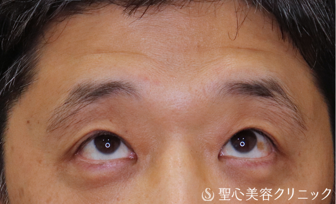 【40代男性・額や眉に力を入れず、楽に目を開けられるように】眼瞼下垂（切開法/腱膜縫縮法）（術後2ヶ月） After 