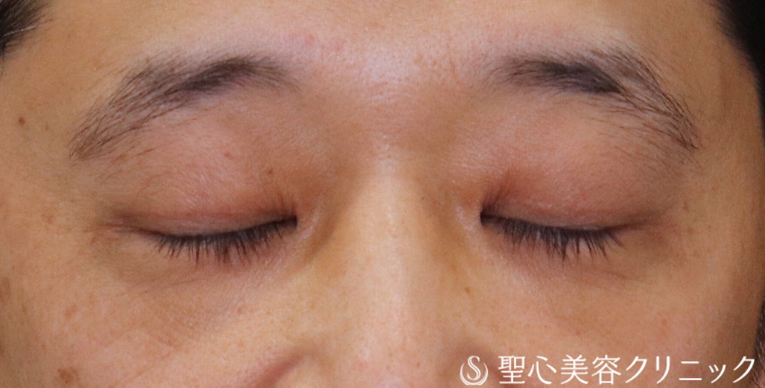 【40代男性・額や眉に力を入れず、楽に目を開けられるように】眼瞼下垂（切開法/腱膜縫縮法）（術後2ヶ月） After 