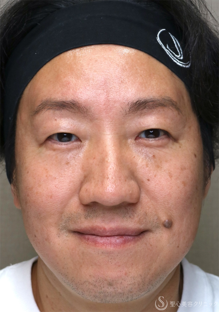 【40代男性・自然な若返りを叶える】表ハムラ法（1週間後～3ヶ月後） After 