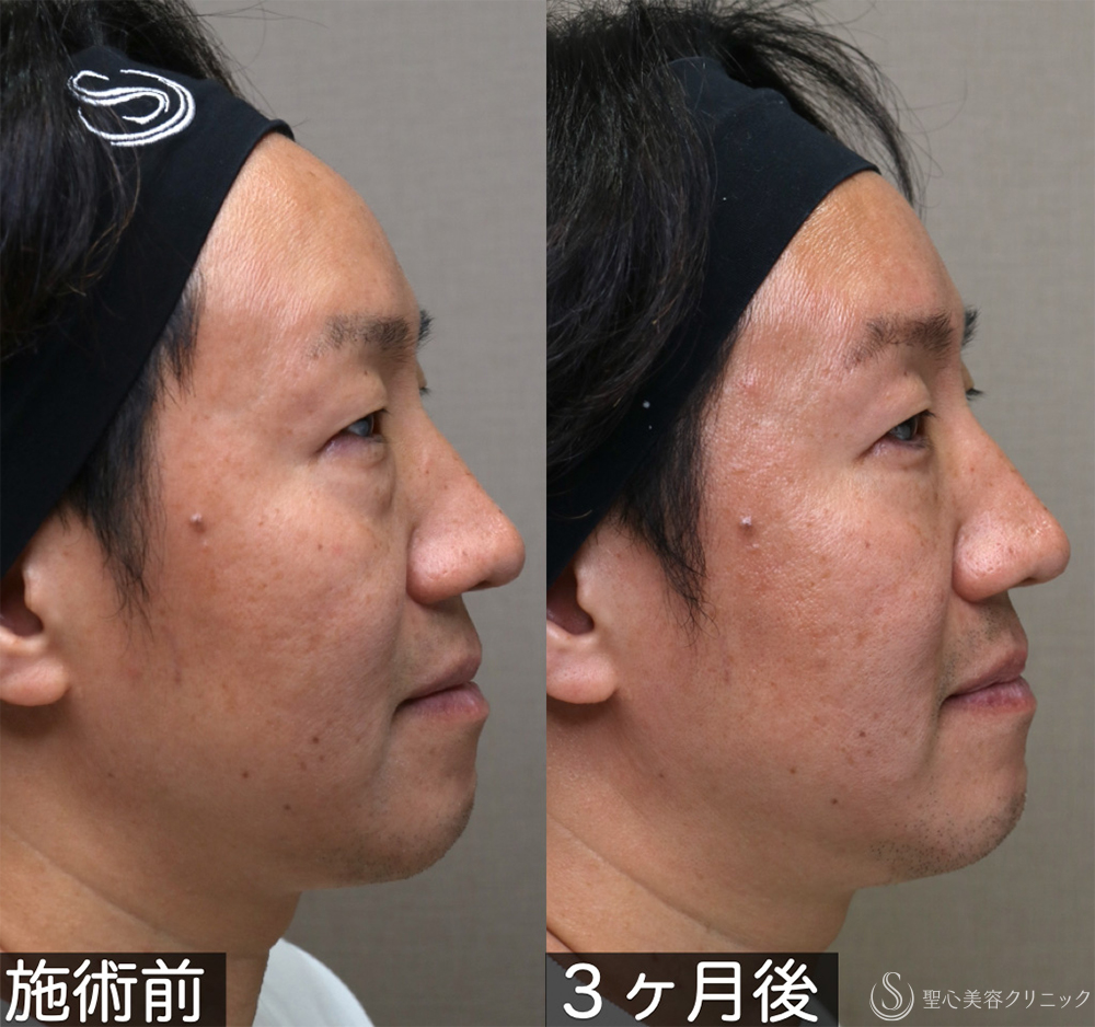 【40代男性・自然な若返りを叶える】表ハムラ法（1週間後～3ヶ月後） After 