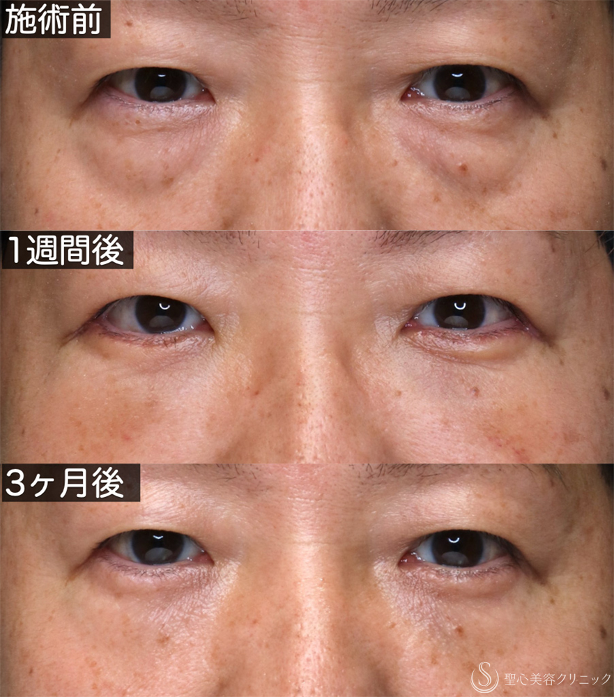 【40代男性・自然な若返りを叶える】表ハムラ法（1週間後～3ヶ月後） After 