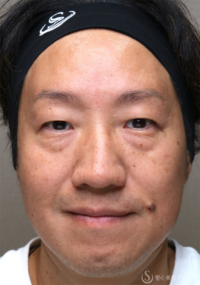 【40代男性・自然な若返りを叶える】表ハムラ法（1週間後～3ヶ月後） Before 