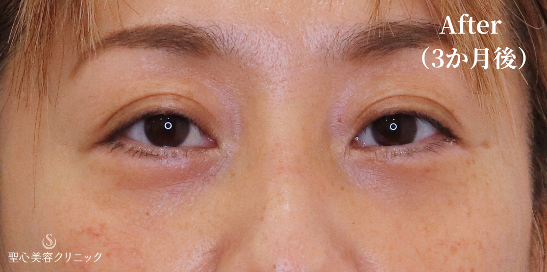 【40代女性・目の下を自然にすっきり】下眼瞼切開術/下眼瞼除皺術/ハムラ法（3ヶ月後） After 