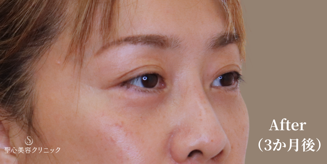 【40代女性・目の下を自然にすっきり】下眼瞼切開術/下眼瞼除皺術/ハムラ法（3ヶ月後） After 