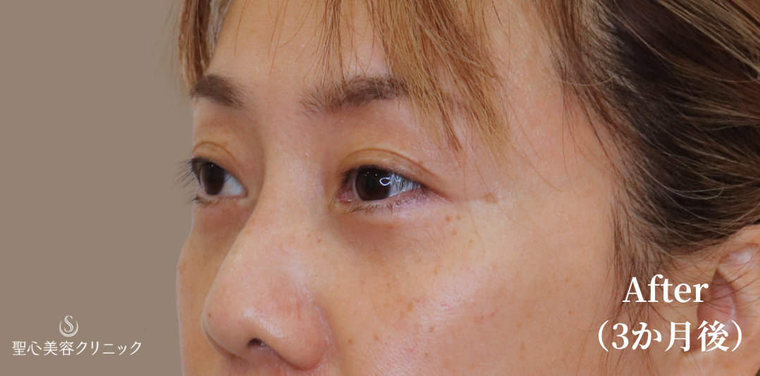 【40代女性・目の下を自然にすっきり】下眼瞼切開術/下眼瞼除皺術/ハムラ法（3ヶ月後） After 