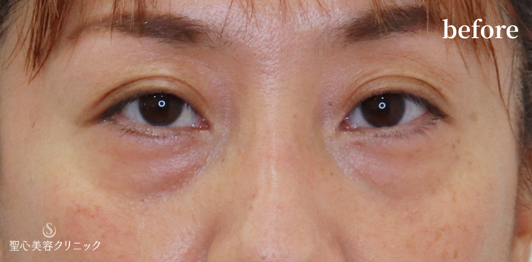 【40代女性・目の下を自然にすっきり】下眼瞼切開術/下眼瞼除皺術/ハムラ法（3ヶ月後） Before 