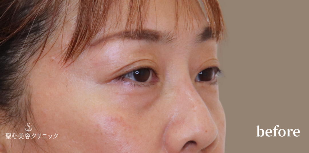 【40代女性・目の下を自然にすっきり】下眼瞼切開術/下眼瞼除皺術/ハムラ法（3ヶ月後） Before 