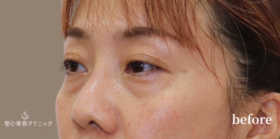 【40代女性・目の下を自然にすっきり】下眼瞼切開術/下眼瞼除皺術/ハムラ法（3ヶ月後） Before 