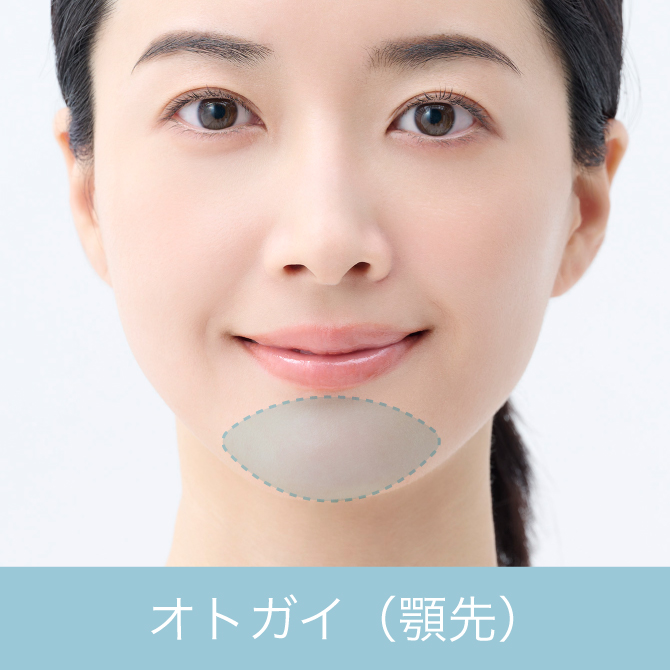 オトガイ（顎先）形成