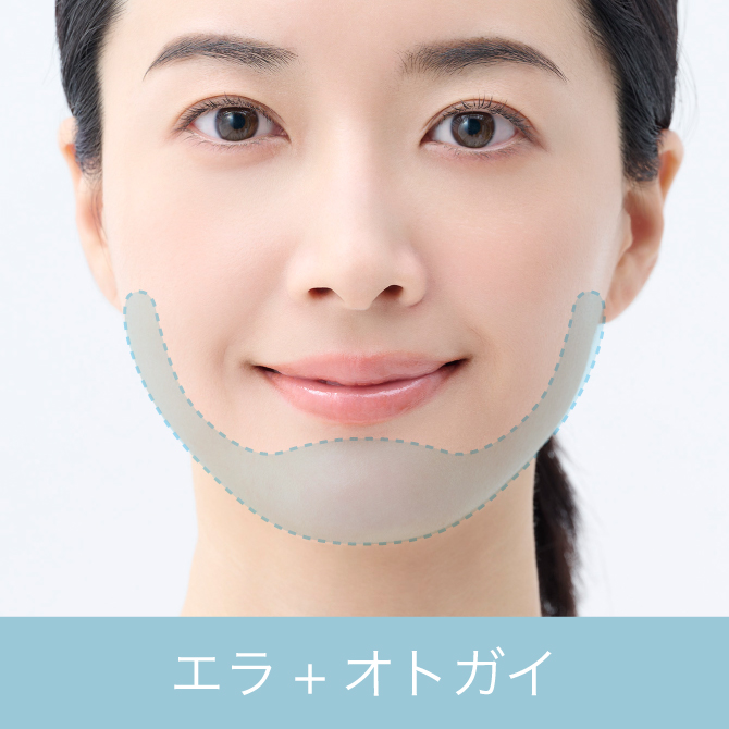 Vライン形成（下顎角（エラ）形成＋オトガイ（顎先）形成）