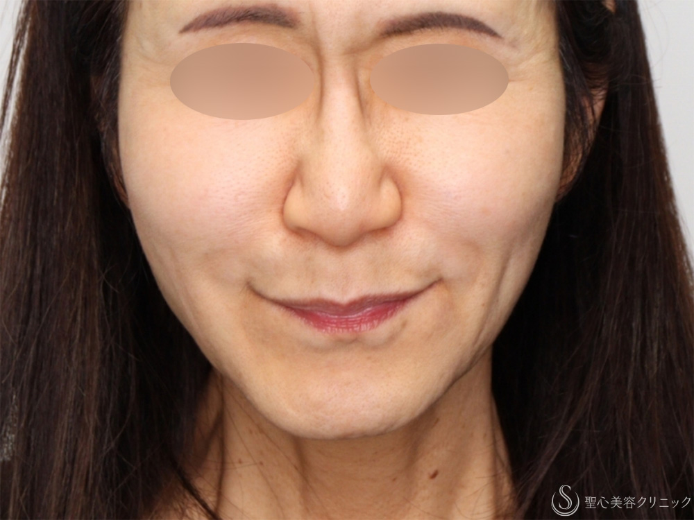 【60代女性・新しい糸リフトでフェイスラインがスッキリ】フィオラFL4本＋サポートスレッド6本（1週間後～1ヶ月後） After 