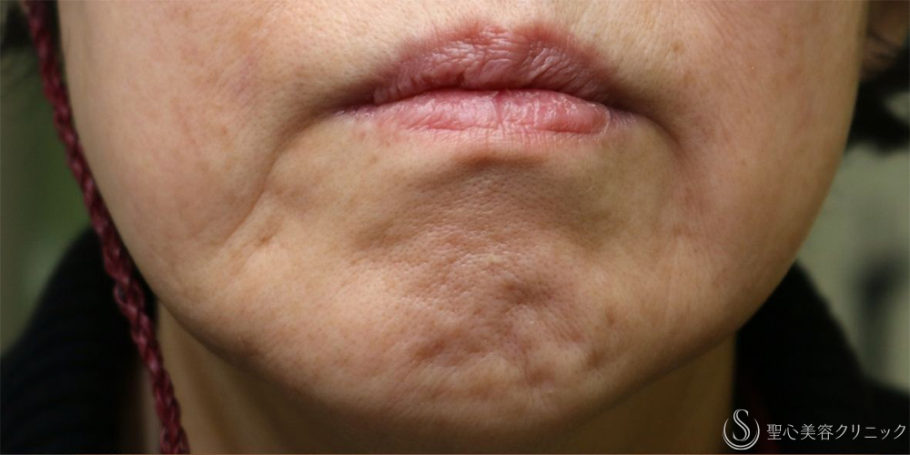 【70代女性・左マリオネットラインの長期経過】プレミアムPRP皮膚再生療法（6年後） Before 
