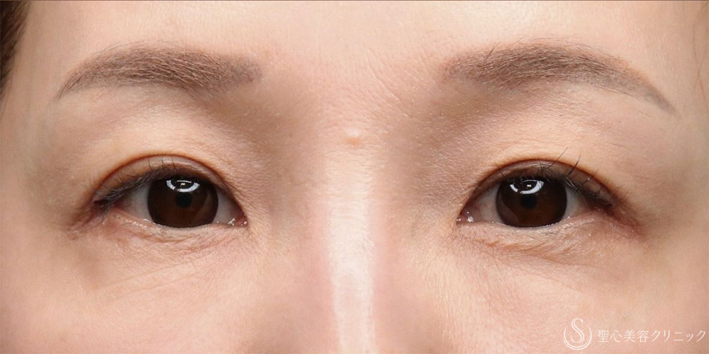 【40代女性・目のくぼみ改善・長期経過】プレミアムPRP皮膚再生療法（5年後） After 名古屋+ヒアルロン酸・しわ・アンチエイジング・肌育