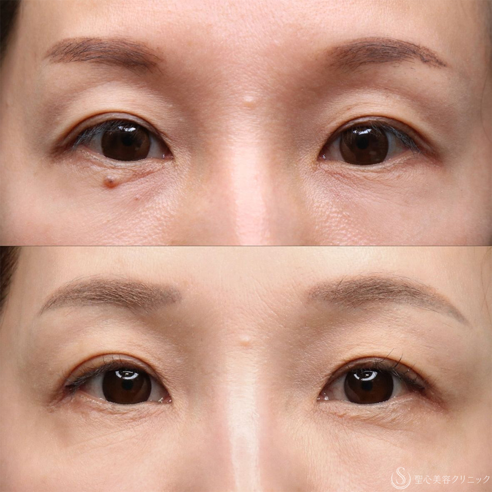 【40代女性・目のくぼみ改善・長期経過】プレミアムPRP皮膚再生療法（5年後） After 名古屋+ヒアルロン酸・しわ・アンチエイジング・肌育