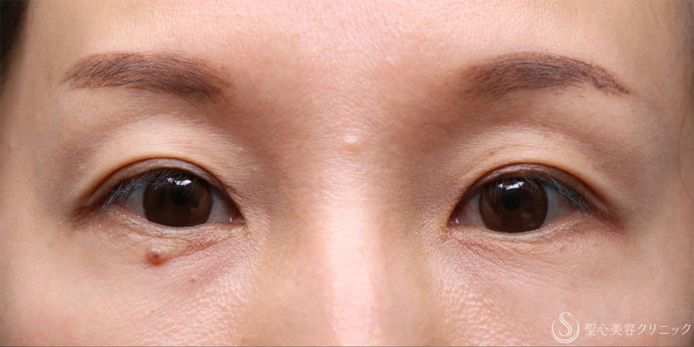 【40代女性・目のくぼみ改善・長期経過】プレミアムPRP皮膚再生療法（5年後） Before 名古屋+ヒアルロン酸・しわ・アンチエイジング・肌育