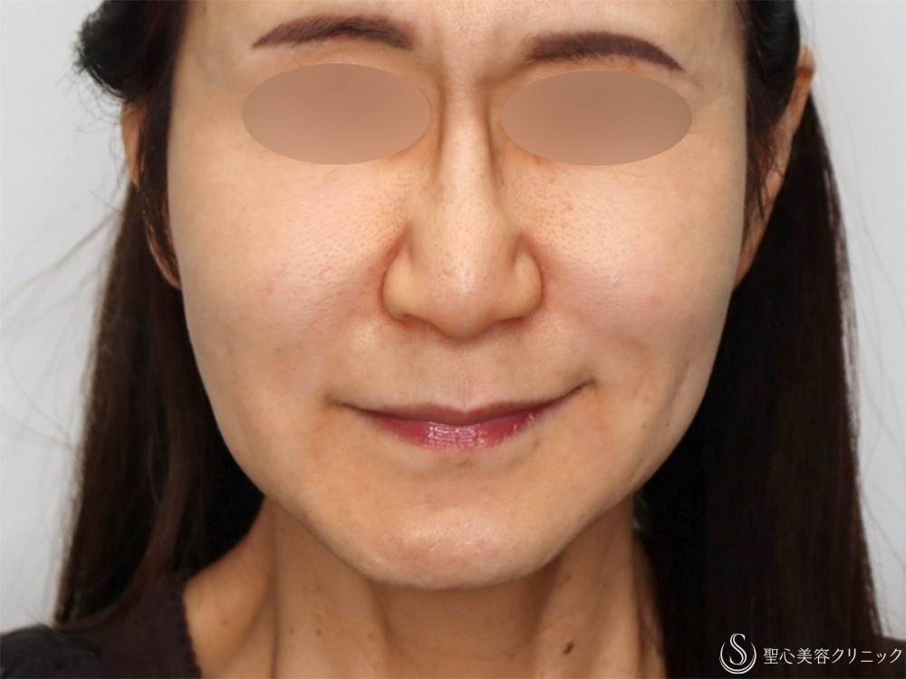 【60代女性・新しい糸リフトでフェイスラインがスッキリ】フィオラFL4本＋サポートスレッド6本（1週間後～1ヶ月後） Before 