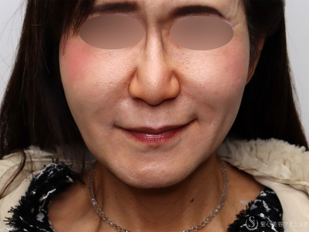 【60代女性・新しい糸リフトでフェイスラインがスッキリ】フィオラFL4本＋サポートスレッド6本（1週間後～1ヶ月後） After 