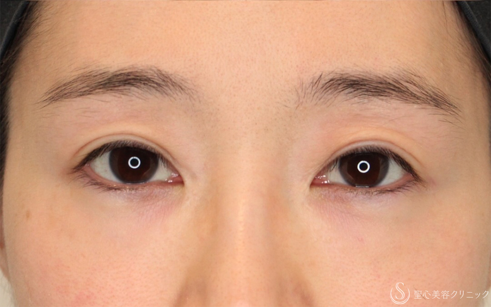 【30代女性・他院全切開修正で左右のバランスを整える】二重全切開（左）（1ヶ月後～3ヶ月後） After 