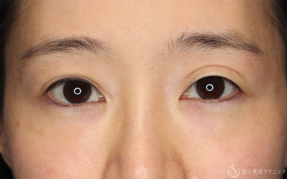 【30代女性・他院全切開修正で左右のバランスを整える】二重全切開（左）（1ヶ月後～3ヶ月後） Before 