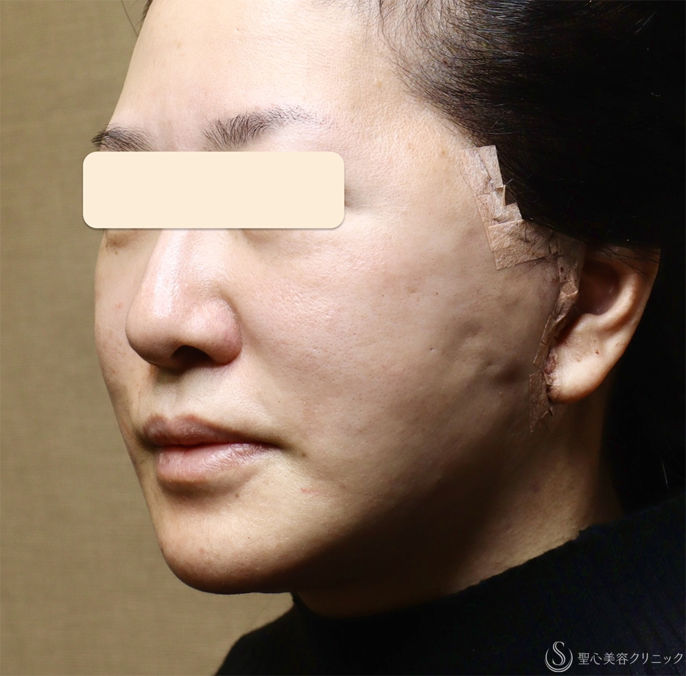 【40代女性・顔の弛み】エクステンデッドディーププレーンフェイスリフト（手術当日） After 