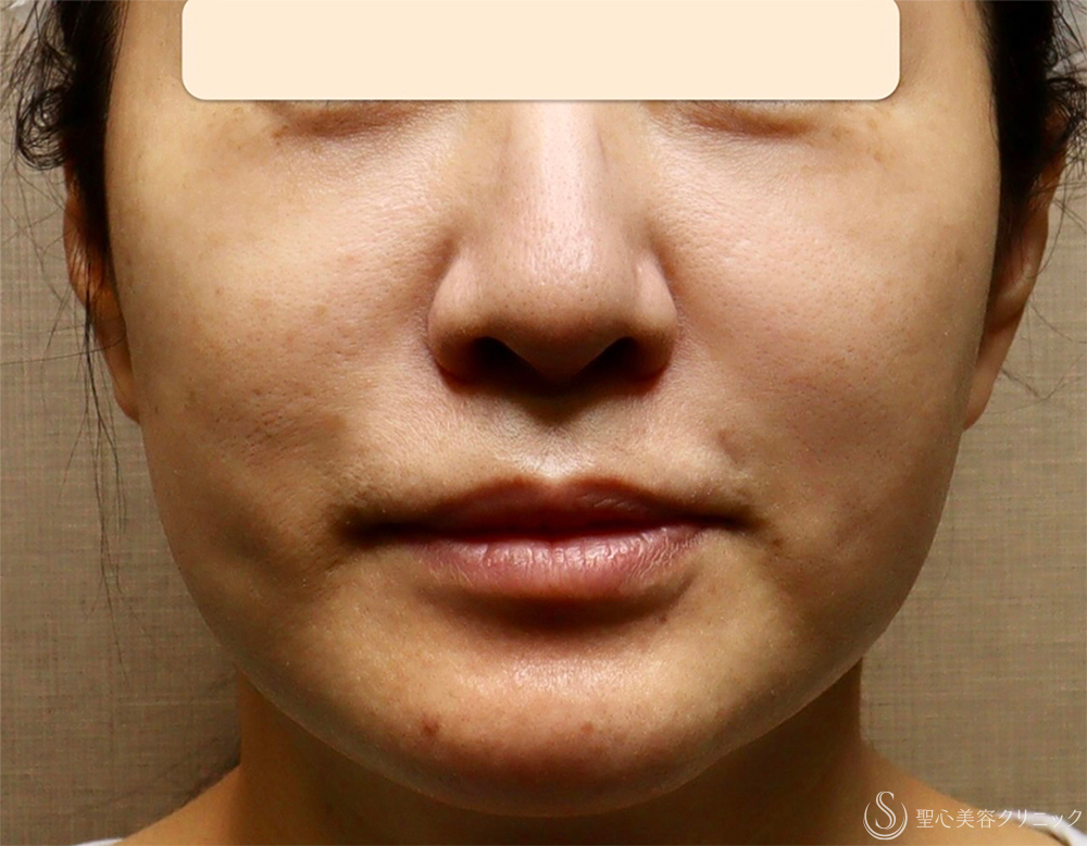 【40代女性・顔の弛み】エクステンデッドディーププレーンフェイスリフト（手術当日） Before 