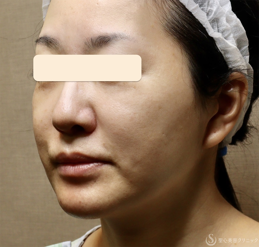 【40代女性・顔の弛み】エクステンデッドディーププレーンフェイスリフト（手術当日） Before 