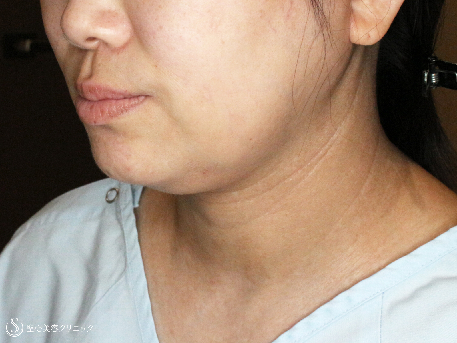 【40代女性・二重あご解消】脂肪吸引注射「あご下」（直後〜1ヶ月後） Before 