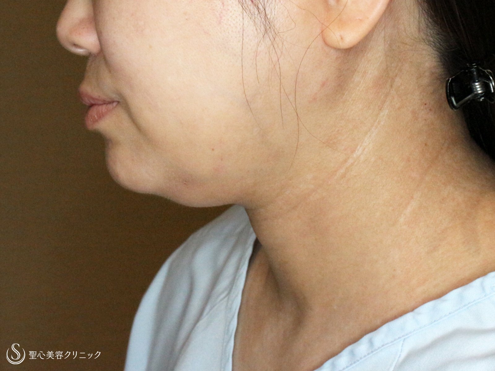 【40代女性・二重あご解消】脂肪吸引注射「あご下」（直後〜1ヶ月後） Before 
