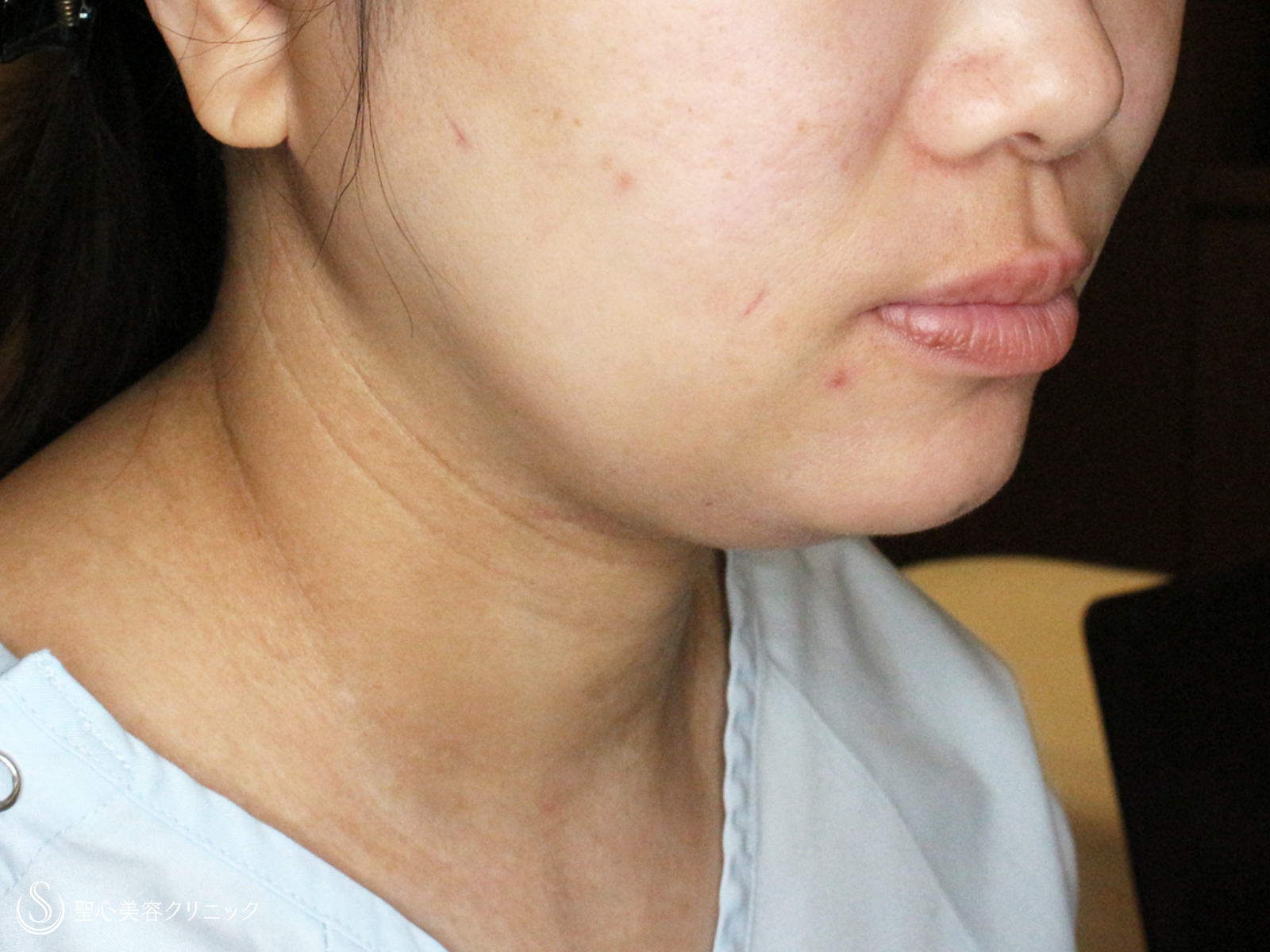 【40代女性・二重あご解消】脂肪吸引注射「あご下」（直後〜1ヶ月後） Before 