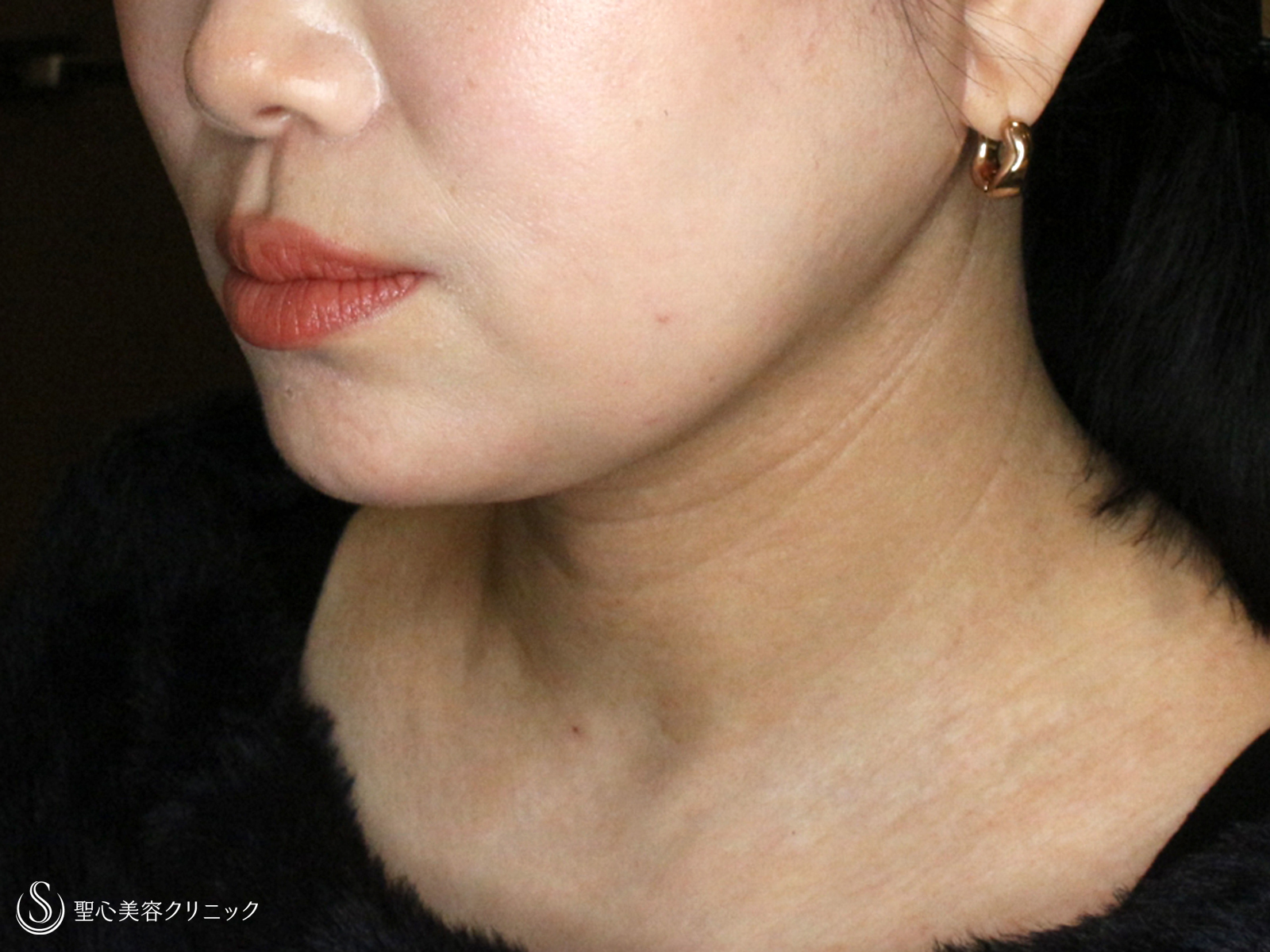 【40代女性・二重あご解消】脂肪吸引注射「あご下」（直後〜1ヶ月後） After 
