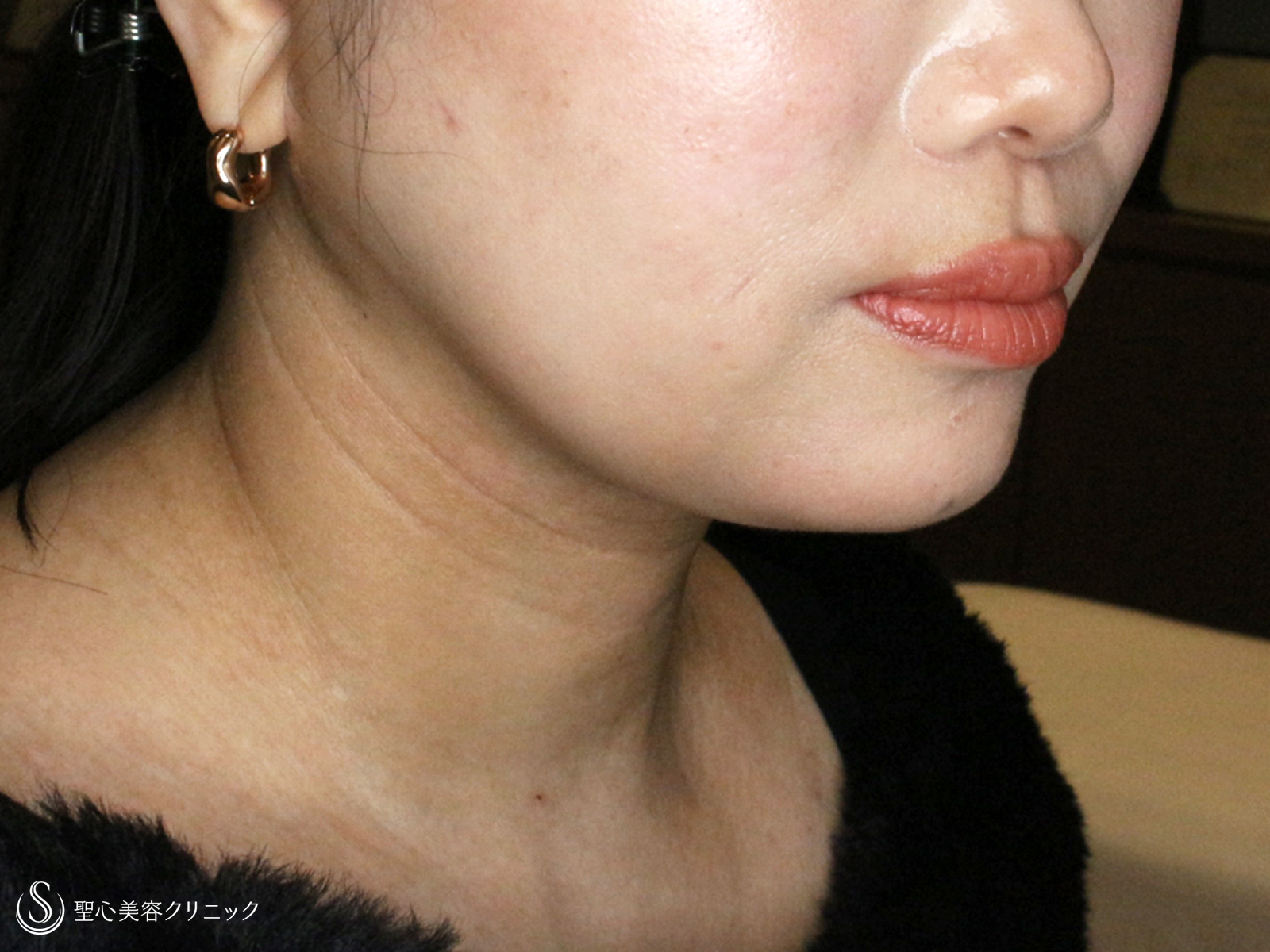 【40代女性・二重あご解消】脂肪吸引注射「あご下」（直後〜1ヶ月後） After 