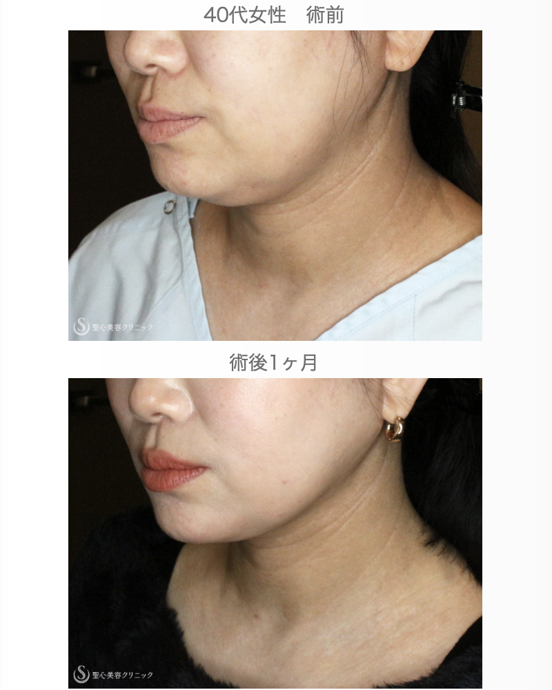 【40代女性・二重あご解消】脂肪吸引注射「あご下」（直後〜1ヶ月後） After 