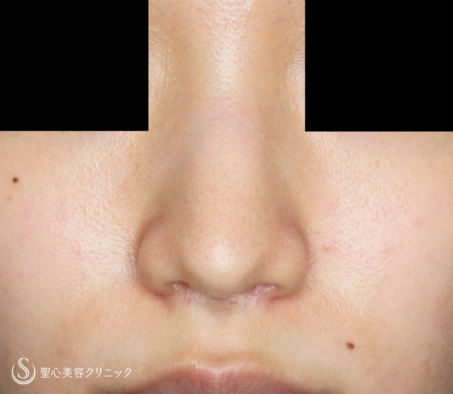 【難易度「特級」忘れ鼻をつくる】小鼻縮小術+α法「Ver.7.5」（直後〜7ヶ月後） After 