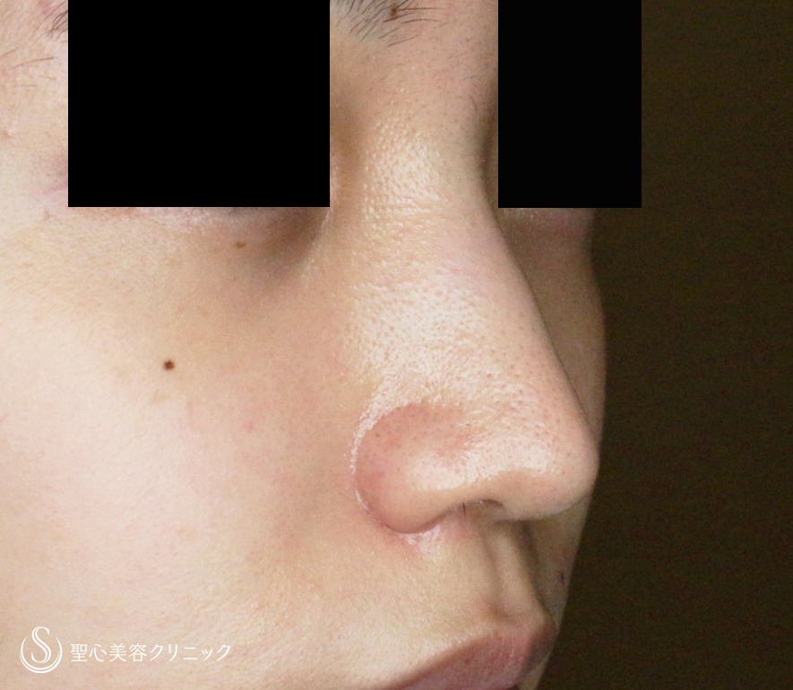 【難易度「特級」忘れ鼻をつくる】小鼻縮小術+α法「Ver.7.5」（直後〜7ヶ月後） After 