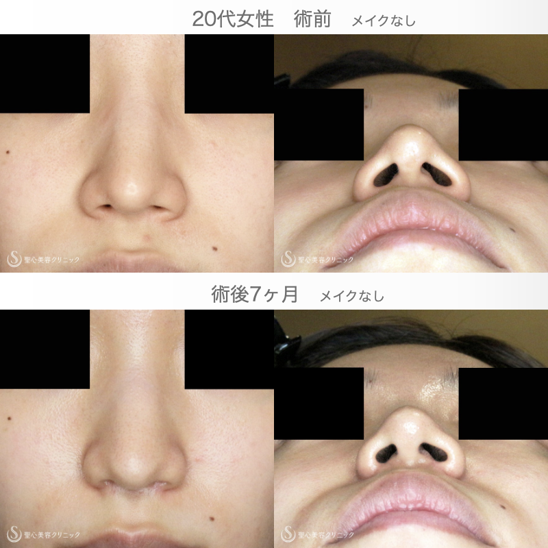 【難易度「特級」忘れ鼻をつくる】小鼻縮小術+α法「Ver.7.5」（直後〜7ヶ月後） After 