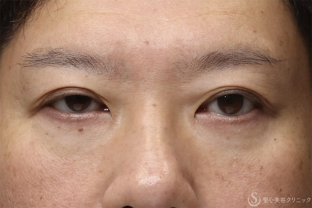 【40代男性・目の開きを改善】眼瞼下垂（腱膜縫縮法）（3ヶ月後） Before 