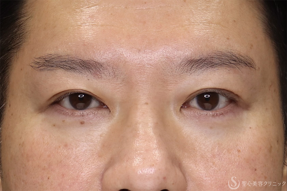 【40代男性・目の開きを改善】眼瞼下垂（腱膜縫縮法）（3ヶ月後） After 