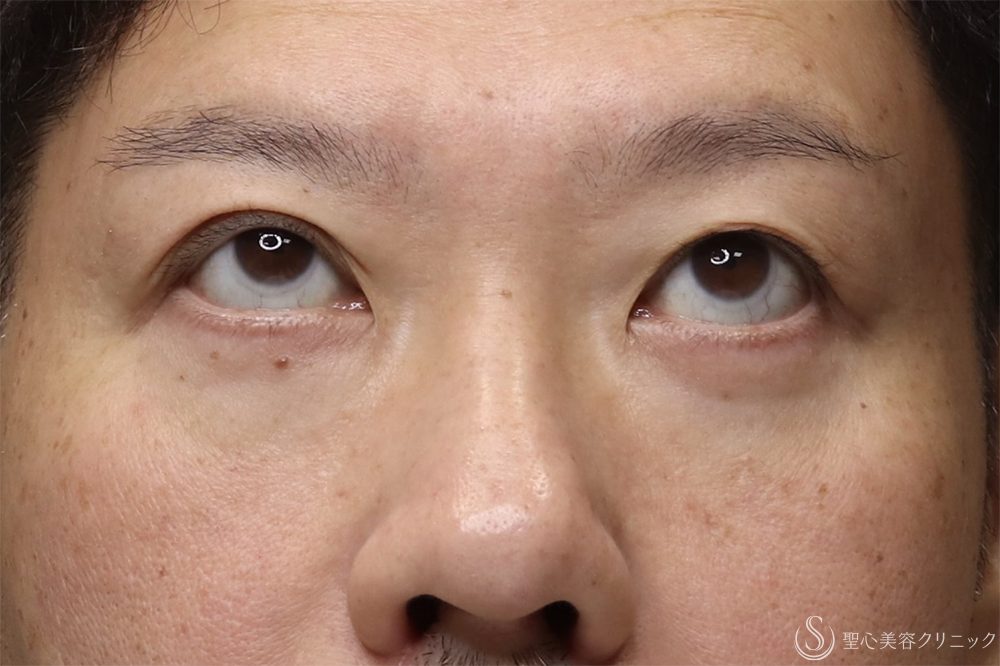 【40代男性・目の開きを改善】眼瞼下垂（腱膜縫縮法）（3ヶ月後） Before 