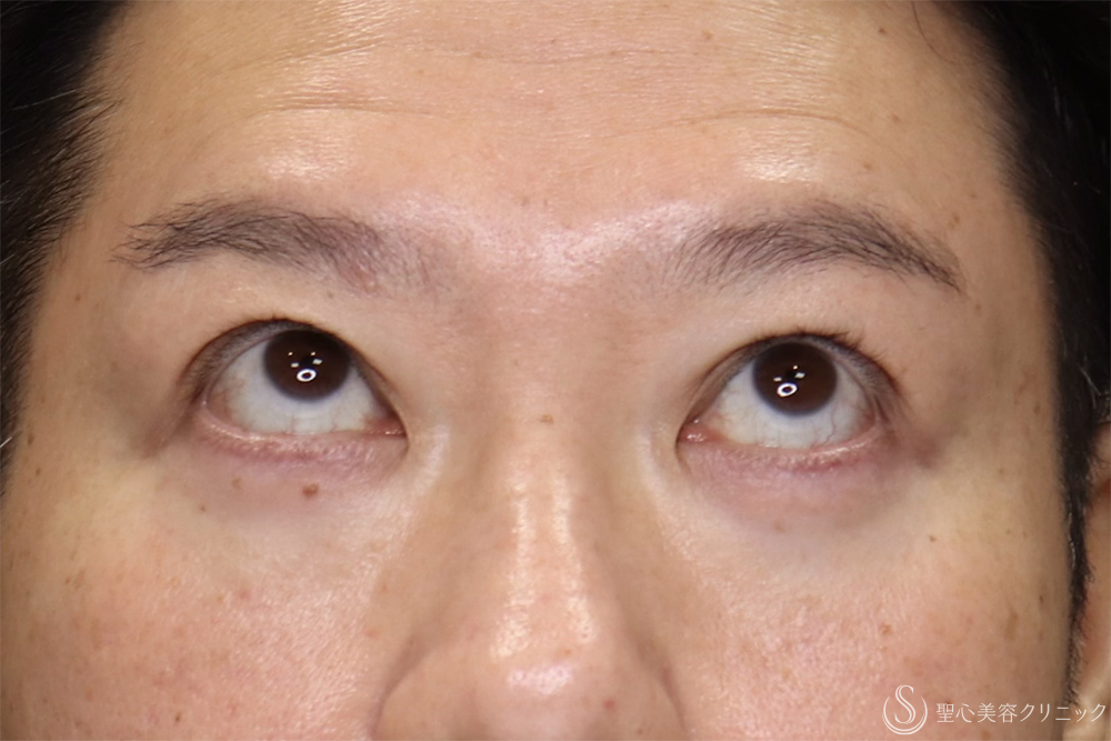 【40代男性・目の開きを改善】眼瞼下垂（腱膜縫縮法）（3ヶ月後） After 
