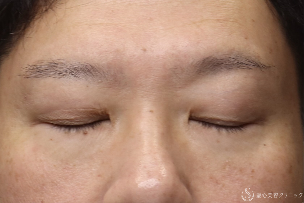 【40代男性・目の開きを改善】眼瞼下垂（腱膜縫縮法）（3ヶ月後） Before 