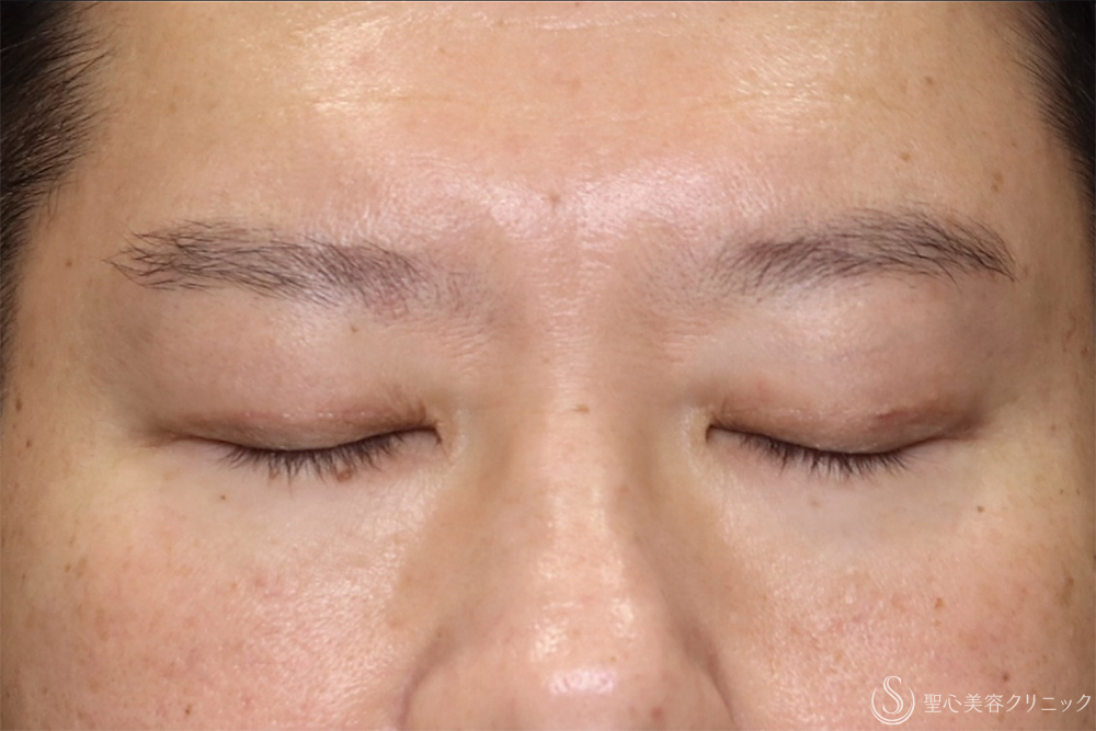 【40代男性・目の開きを改善】眼瞼下垂（腱膜縫縮法）（3ヶ月後） After 