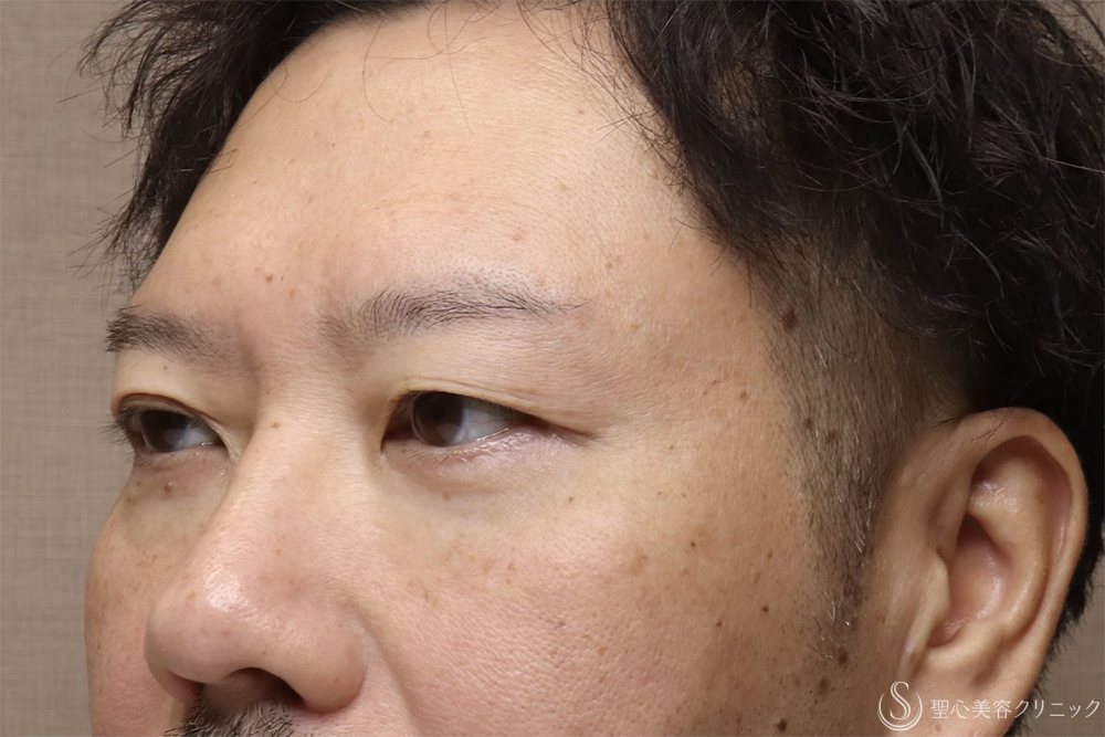 【40代男性・目の開きを改善】眼瞼下垂（腱膜縫縮法）（3ヶ月後） Before 